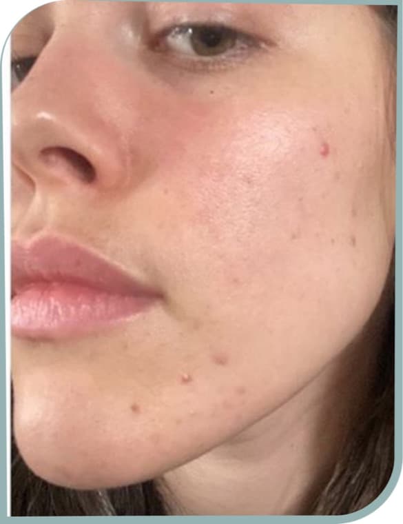 Post-acne marks, After photo (result 5 of 6)