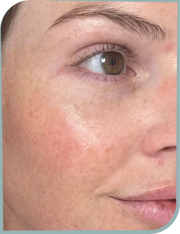 Cheek pigmentation, After photo (result 2 of 10)