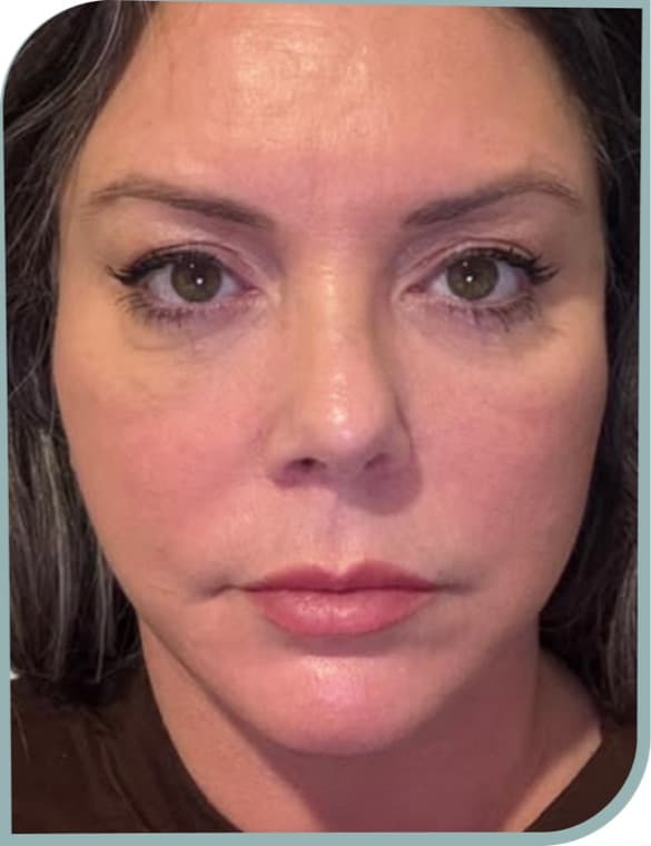 Dull, tired skin, After photo