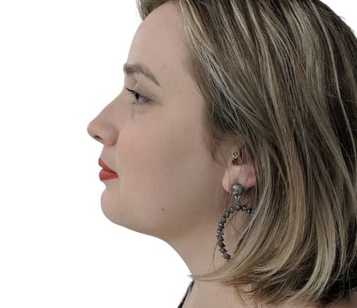 YOUR JAWLINE, REDEFINED — After photo (result 1 of 3)