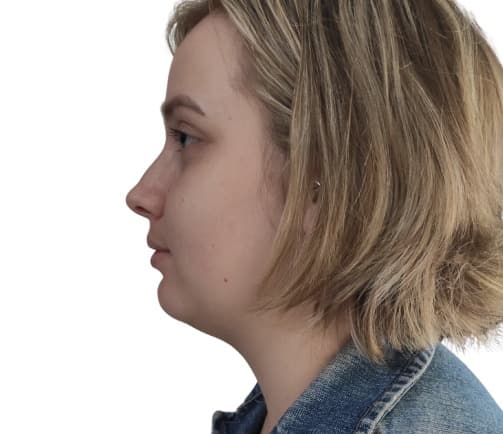 YOUR JAWLINE, REDEFINED — Before photo (result 1 of 3)