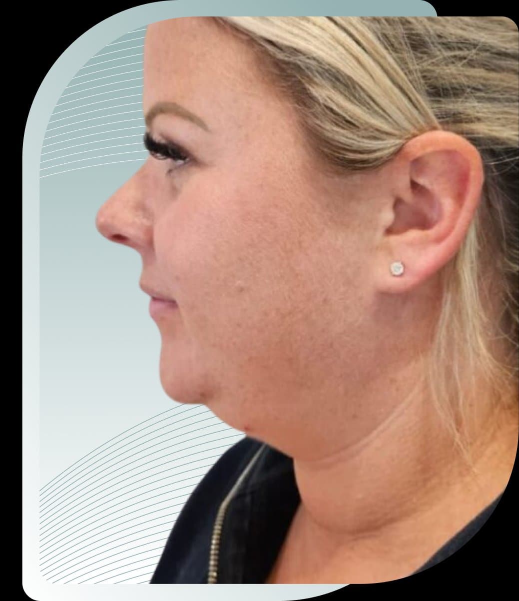 Snatch Your Jawline, doctor-led jawline treatment at Carisma Aesthetics, Malta