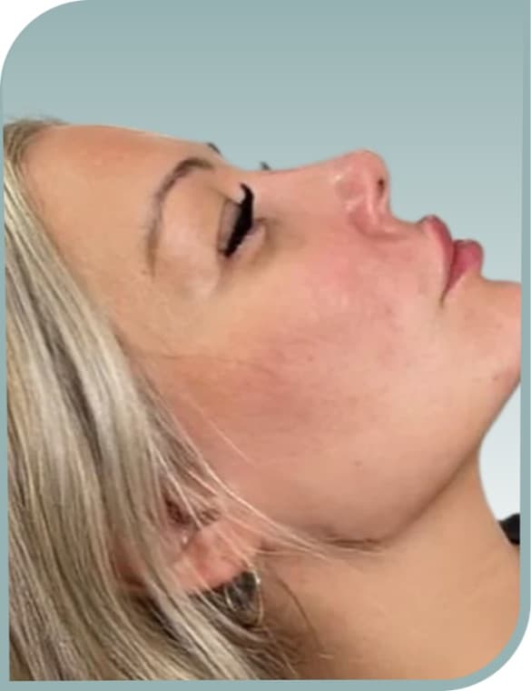 Under-chin fullness, Before photo (result 1 of 10)