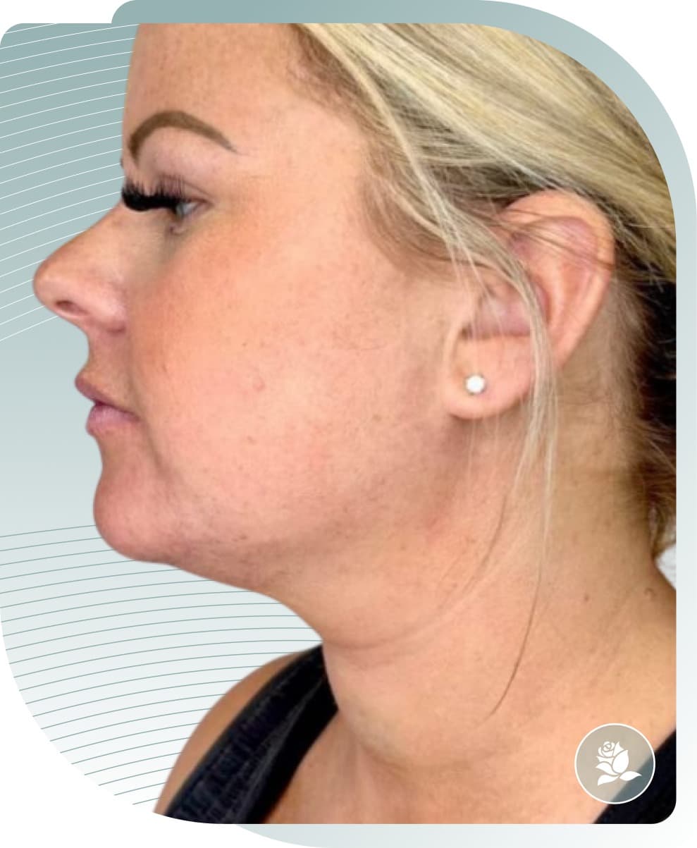 Double Chin Reduction — After photo (result 1 of 5)