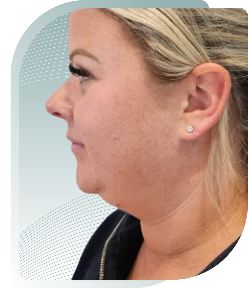 YOUR JAWLINE, REDEFINED — Before photo (result 2 of 3)