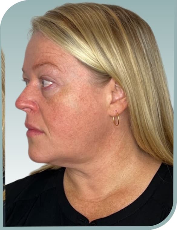 Jowl and neck, After photo (result 10 of 10)