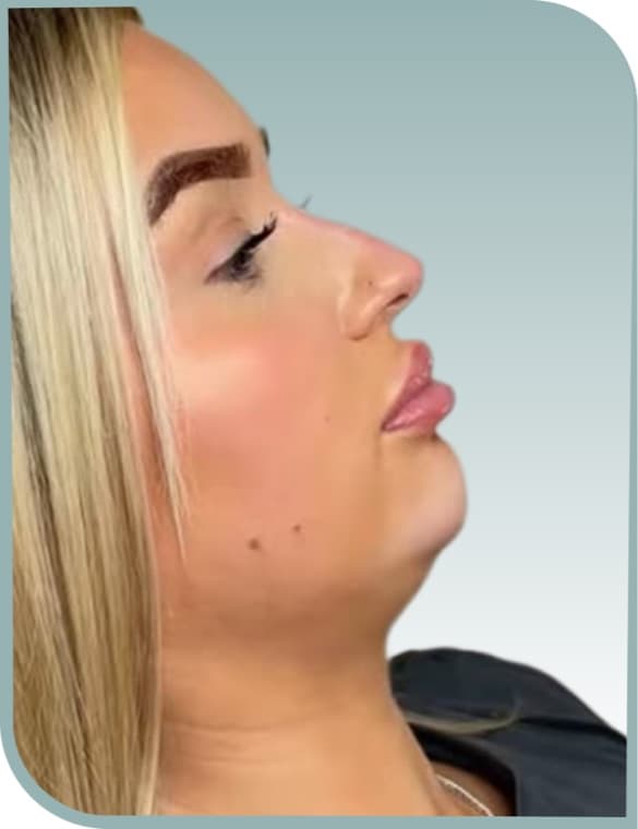 Double chin, Before photo (result 2 of 10)