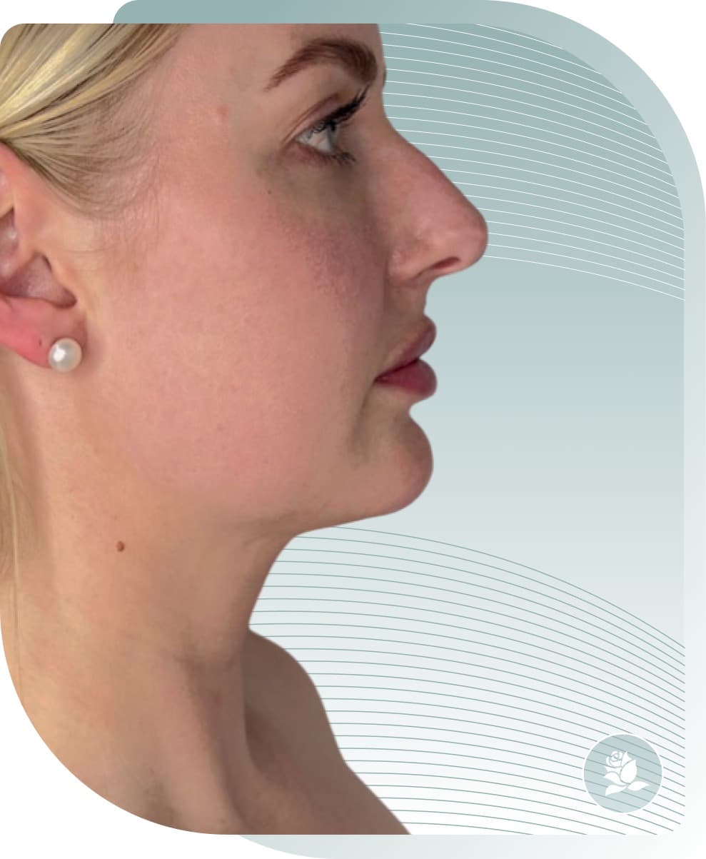 Jawline Contouring — After photo (result 2 of 5)