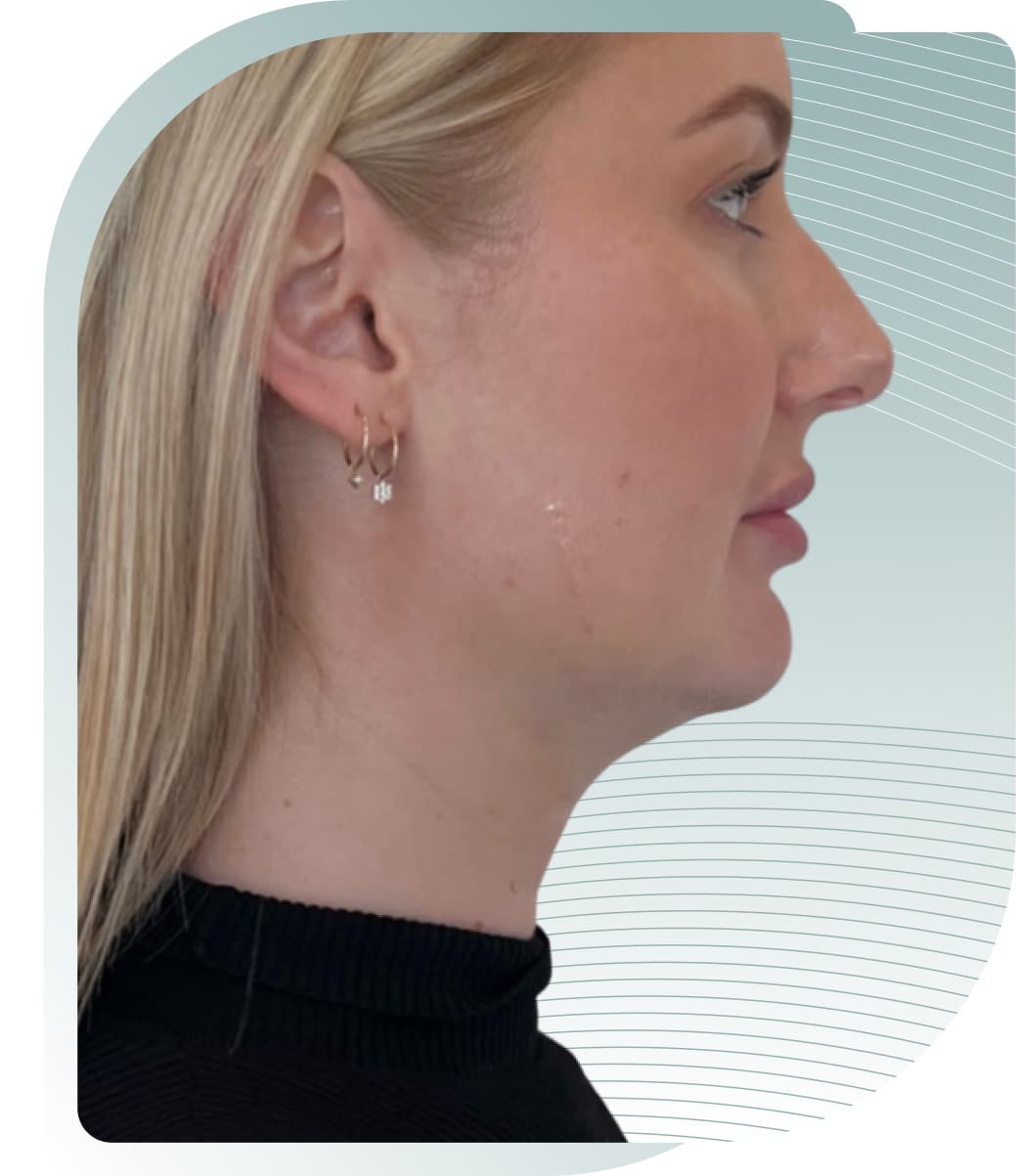 YOUR JAWLINE, REDEFINED — Before photo (result 3 of 3)