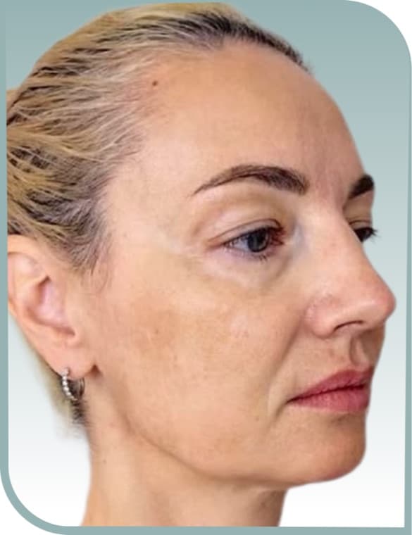 Lower face fullness, Before photo (result 3 of 10)