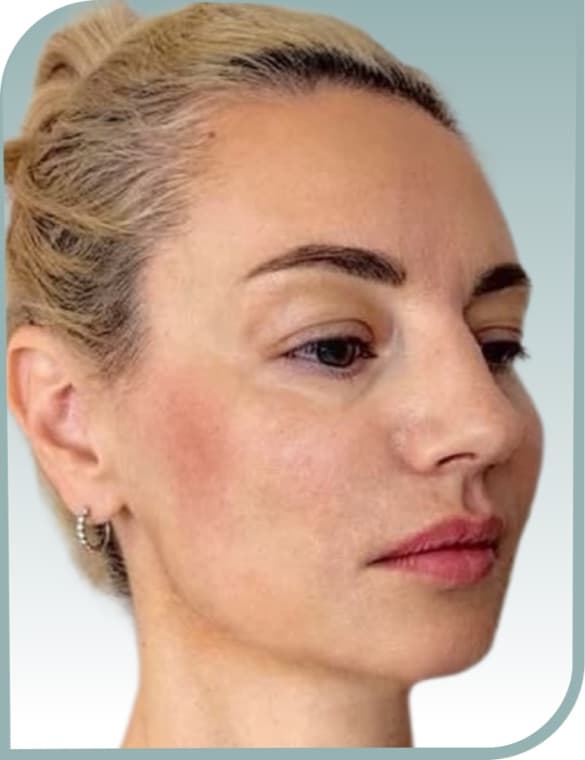 Lower face fullness, After photo (result 3 of 10)