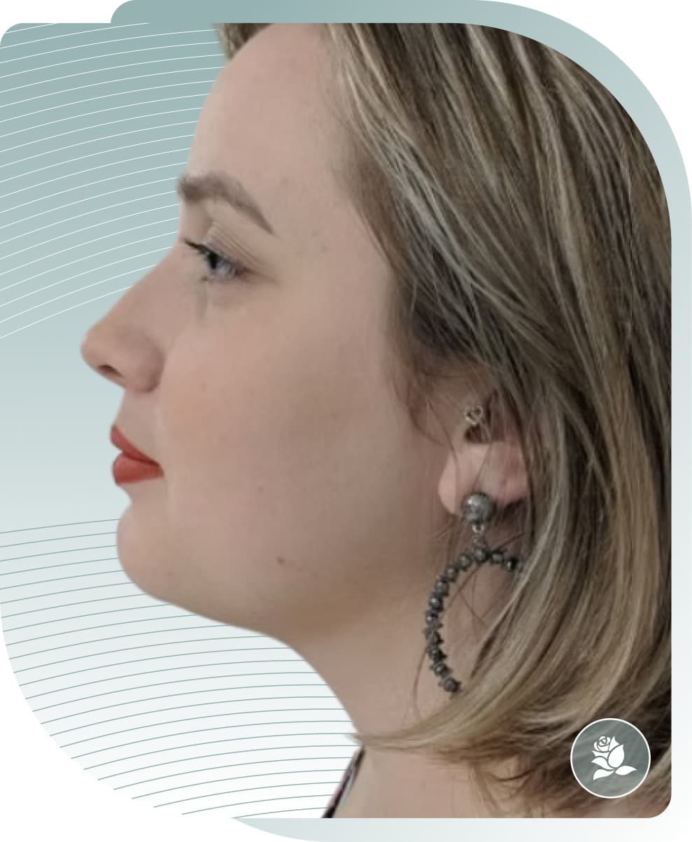 Under Chin Fat Reduction — After photo (result 3 of 5)