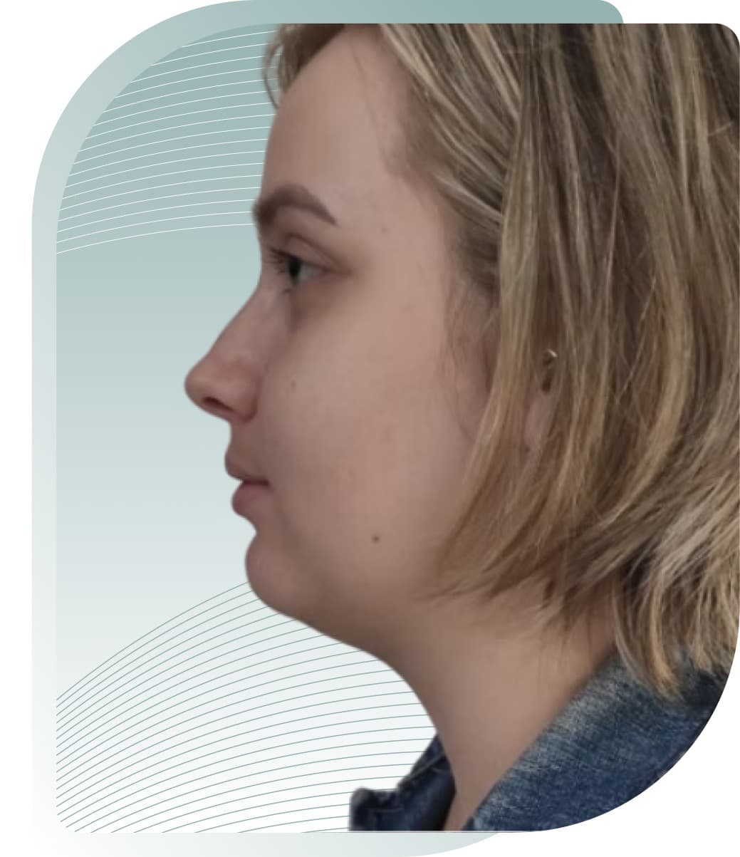 Under Chin Fat Reduction — Before photo (result 3 of 5)
