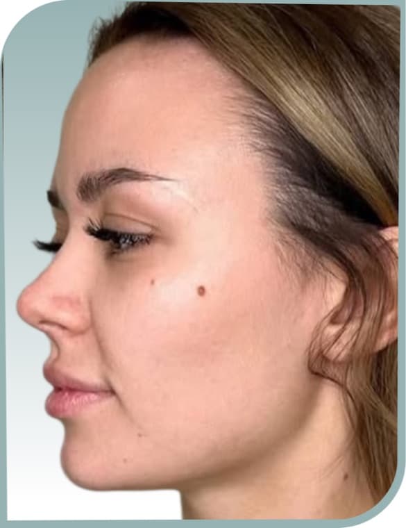 Jawline contour, After photo (result 4 of 10)