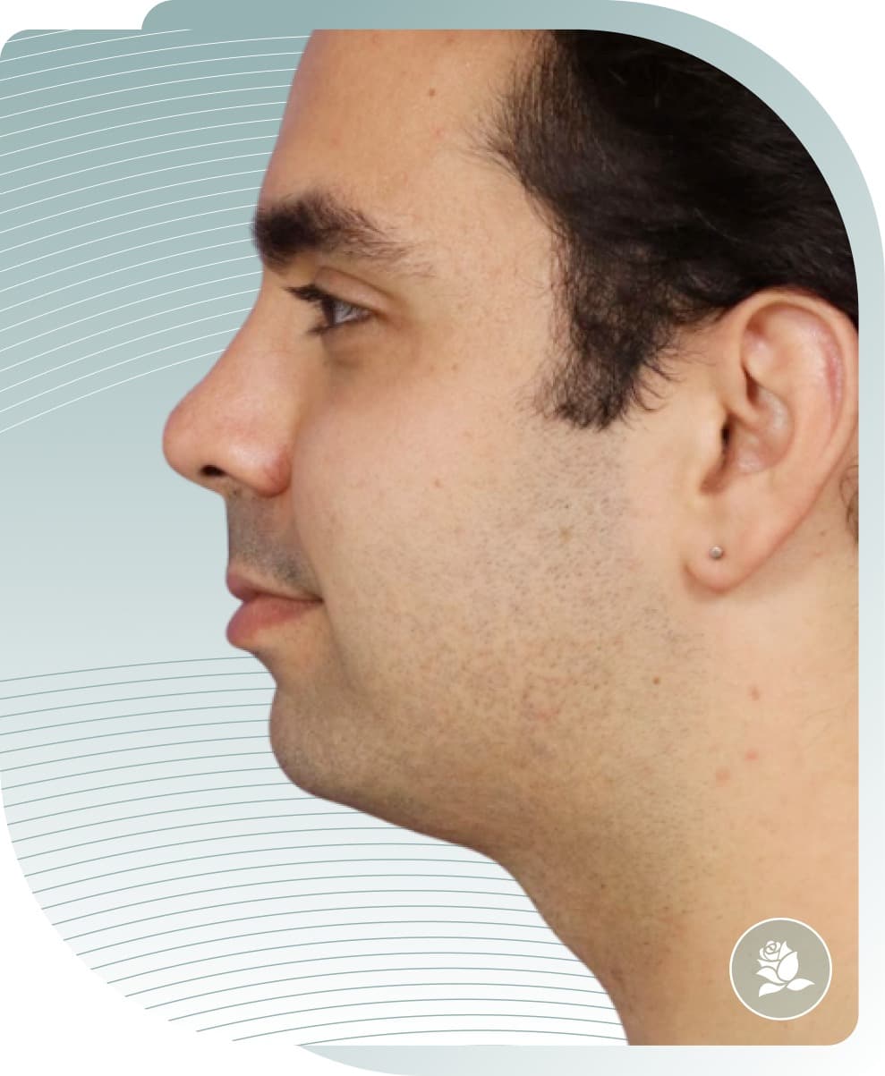 Chin & Neck Sculpting — After photo (result 4 of 5)