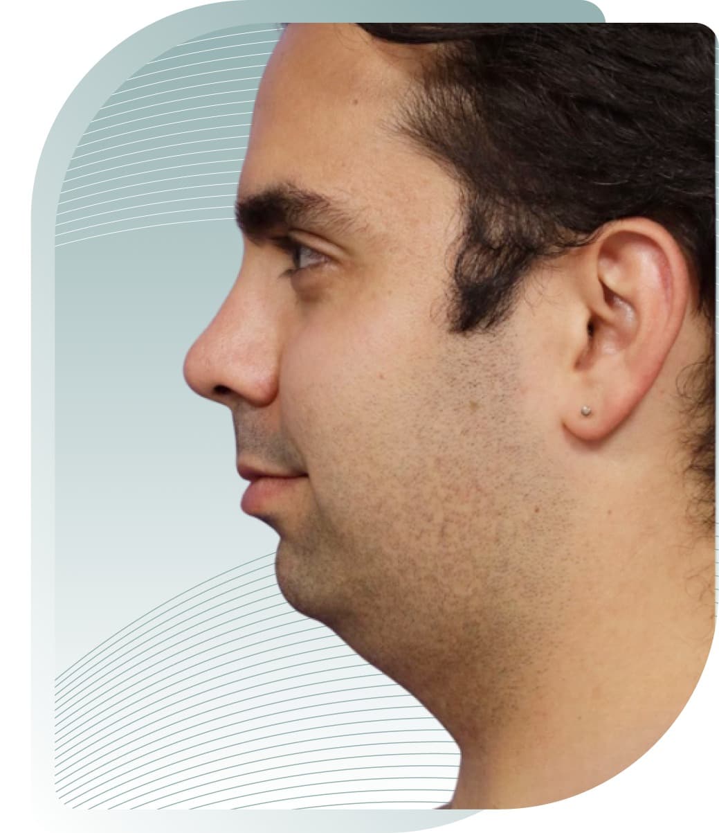 Chin & Neck Sculpting — Before photo (result 4 of 5)