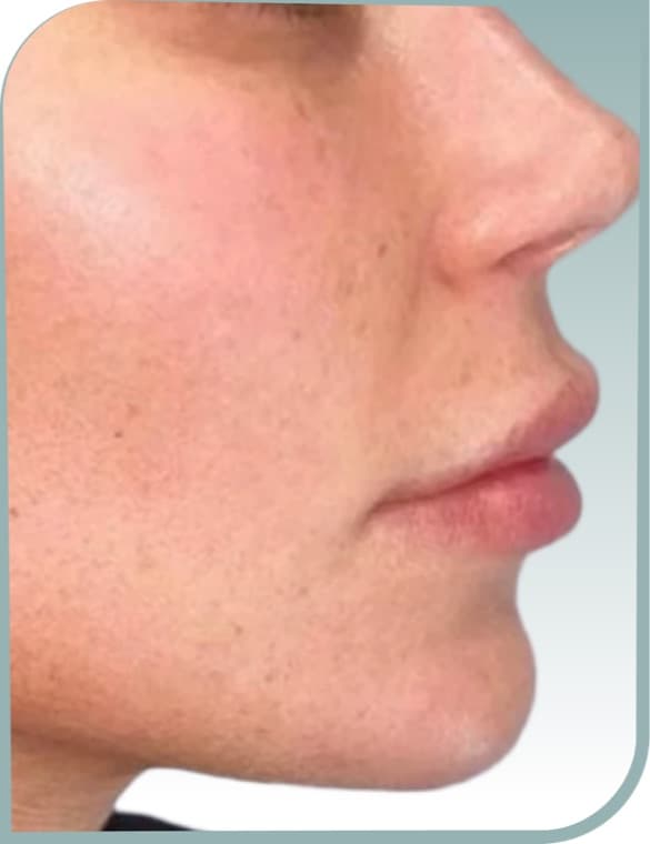 Chin and jaw, After photo (result 5 of 10)