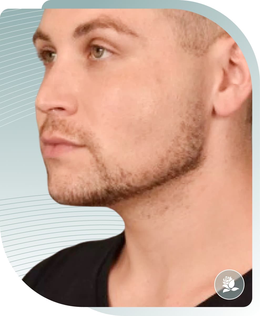 Facial Contouring — After photo (result 5 of 5)