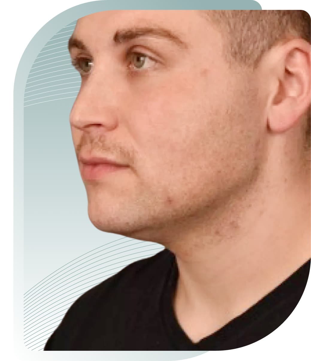 Facial Contouring — Before photo (result 5 of 5)