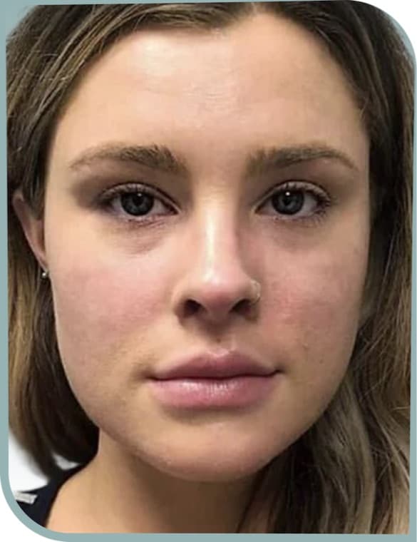 Cheek fullness, Before photo (result 6 of 10)