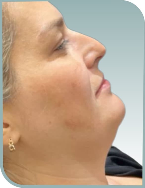 Submental fat, Before photo (result 8 of 10)