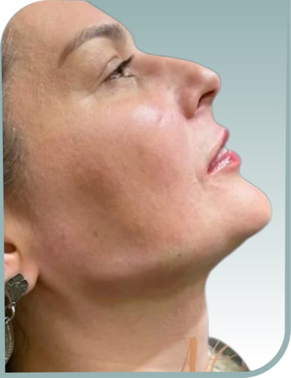 Submental fat, After photo (result 8 of 10)