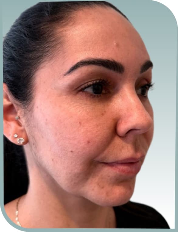 Cheek and jaw, Before photo (result 9 of 10)