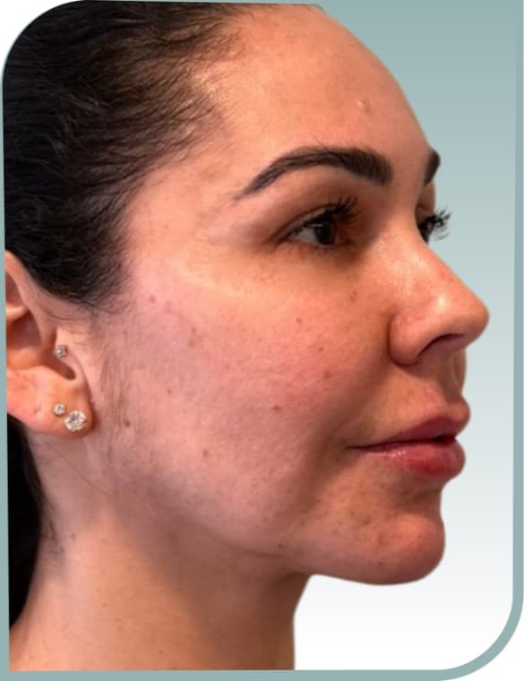 Cheek and jaw, After photo (result 9 of 10)