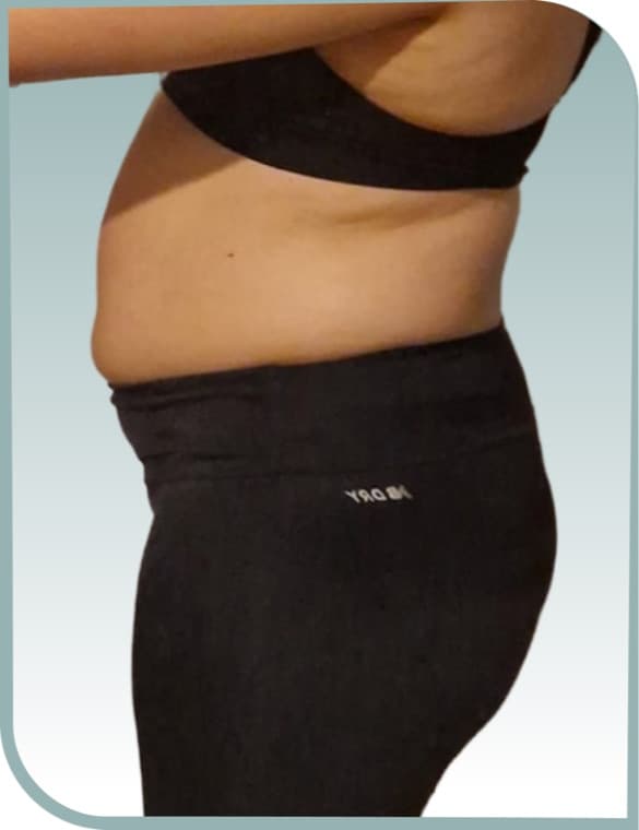 Protruding tummy, Before photo (result 2 of 10)