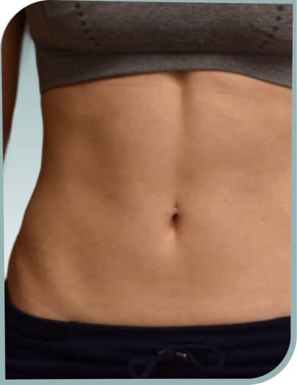 Stomach fat, After photo (result 10 of 10)