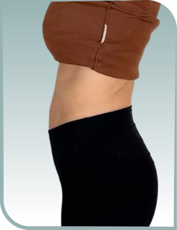 Rounded lower belly, Before photo (result 3 of 10)
