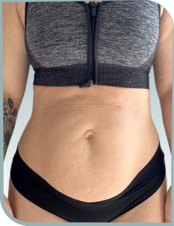 Post pregnancy tummy, After photo (result 4 of 10)
