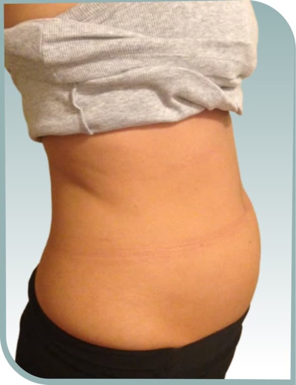 Rounded lower belly, After photo (result 3 of 10)