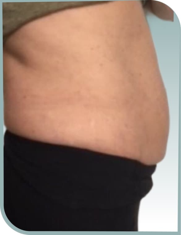 Waistline fat, Before photo (result 6 of 10)