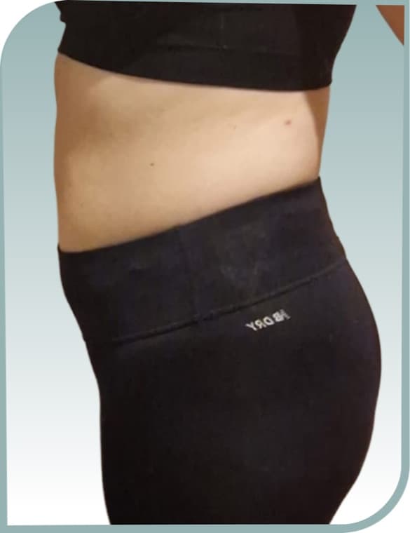 Protruding tummy, After photo (result 2 of 10)
