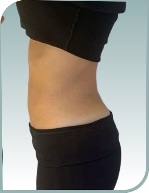Waistline fat, After photo (result 6 of 10)