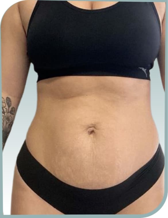 Post pregnancy tummy, Before photo (result 4 of 10)