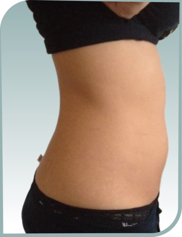 Flank fat, After photo (result 7 of 10)