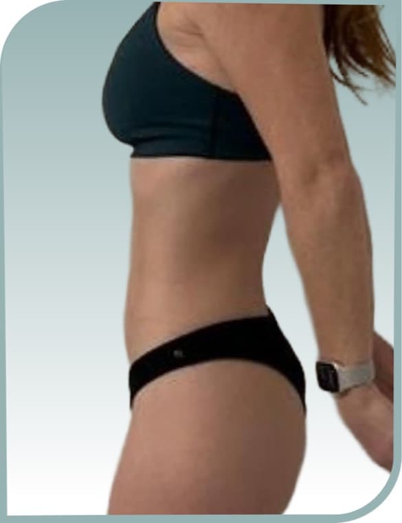Lower tummy pooch, After photo (result 5 of 10)