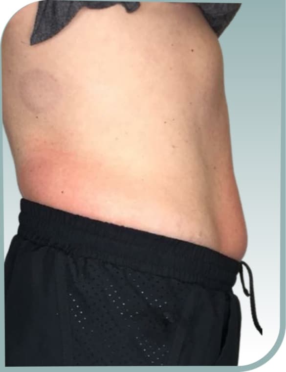 Flank fat, Before photo (result 7 of 10)