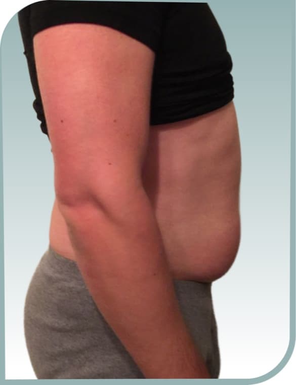 Belly fat, Before photo (result 8 of 10)