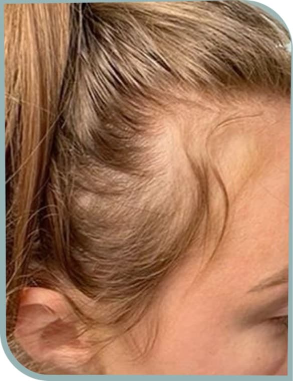 Thinning temple hairline, Before photo (result 1 of 10)