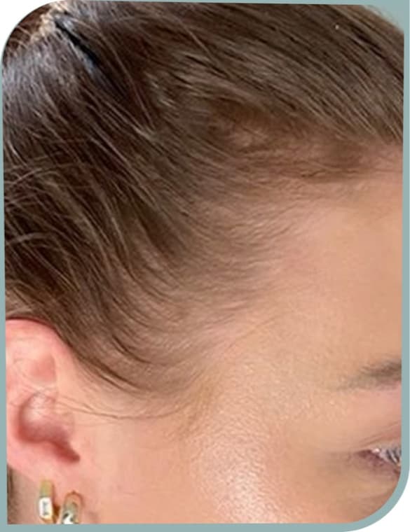 Thinning temple hairline, After photo (result 1 of 10)