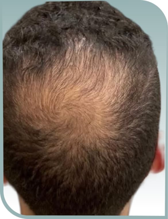 Crown thinning patch, Before photo (result 10 of 10)