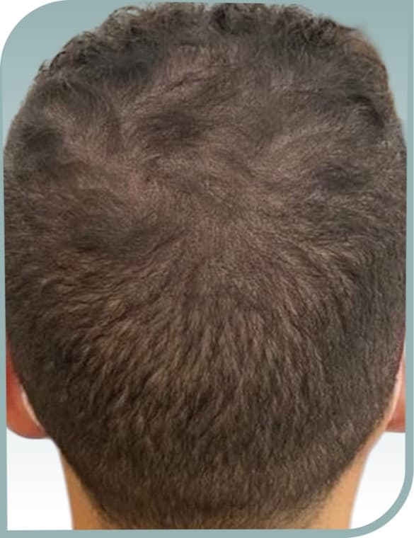 Crown thinning patch, After photo (result 10 of 10)