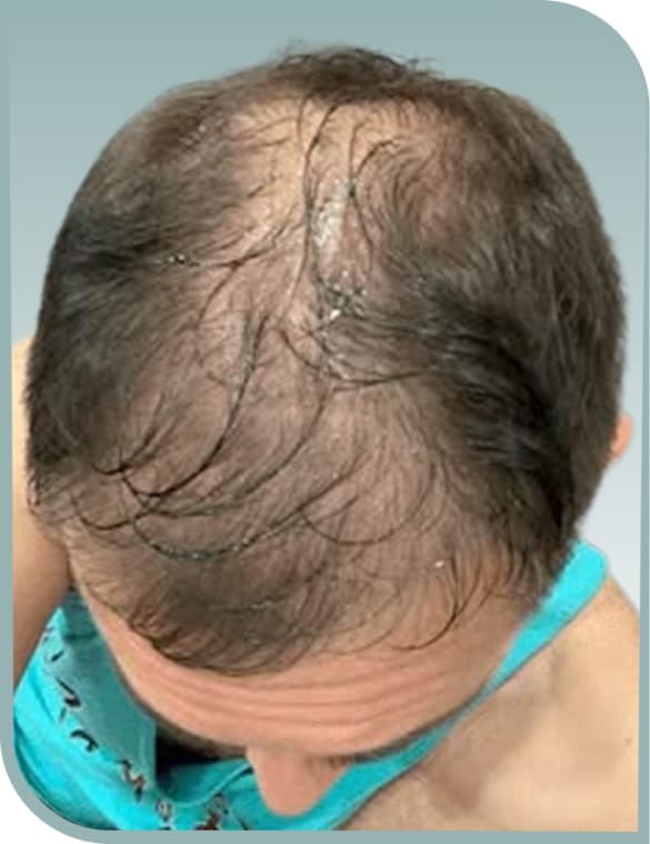 Diffuse crown thinning, Before photo (result 2 of 10)
