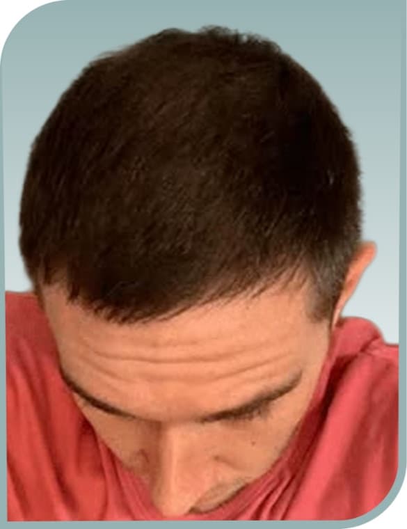 Diffuse crown thinning, After photo (result 2 of 10)