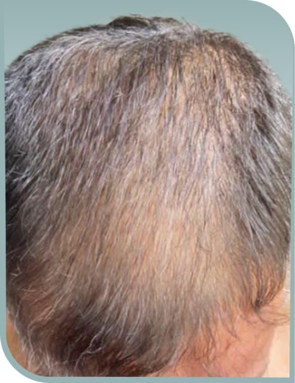 Frontal scalp thinning, Before photo (result 3 of 10)