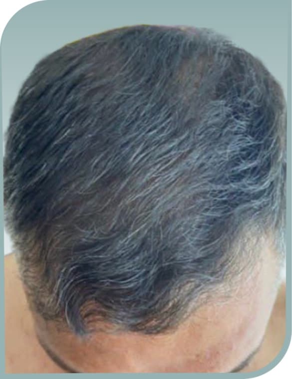 Frontal scalp thinning, After photo (result 3 of 10)