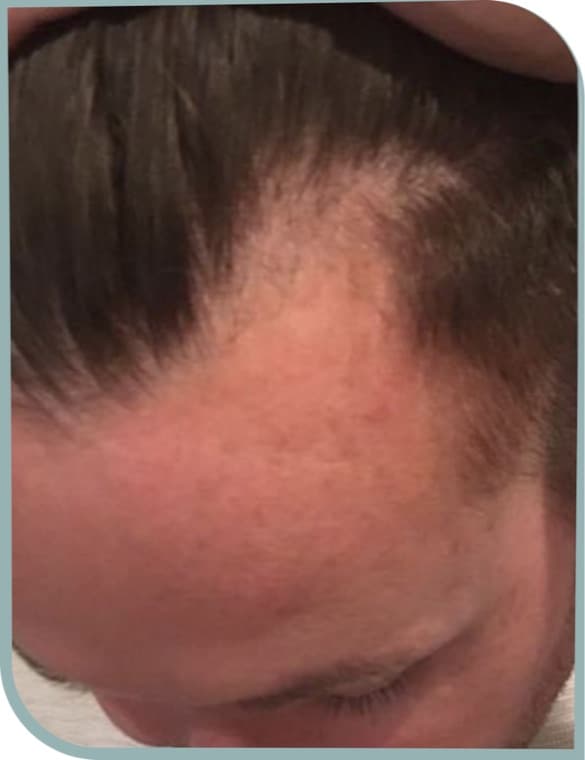 Receding frontal hairline, Before photo (result 4 of 10)